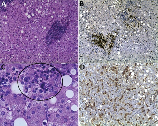 Thumbnail of Histopathologic appearance of liver biopsy sample from woman with fatal human monocytic ehrlichiosis, Mexico, 2013. A) Clusters of cells in the liver lobule. Hematoxylin and eosin (H&amp;E) stain; original magnification ×200. B) Immunohistochemical detection of T lymphocytes (CD3). Original magnification ×100. C) Multinucleated cells in parenchyma (circle). H&amp;E stain; original magnification ×400. D) Immunohistochemical detection of macrophages and hyperplasia of Kupffer cells (C
