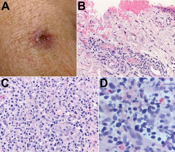 A) Eschar on the right arm of patient 1 at the site of tick bite sustained in Santa Cruz County, Arizona, USA. B) Histological appearance of the eschar biopsy specimen showing ulcerated epidermis with hemorrhage and perivascular lymphohistiocytic inflammatory infiltrates in the superficial dermis. Hematoxylin-eosin staining; original magnification ×50. C) Dense lymphohistiocytic infiltrates around eccrine ducts in the deep dermis of the biopsy specimen. Hematoxylin-eosin staining; original magni