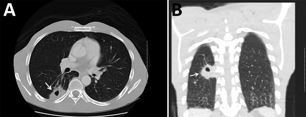 Computed tomography images of the chest of an HIV-infected 47-year-old man (case-patient 3) with Cryptococcus gattii complex infection, southeastern United States. Transverse (A) and frontal (B) views without intravenous contrast showed a mass (arrows) (4.0 cm × 2.5 cm) that had central cavitation posteriorly in the right lower lobe abutting the pleural surface. The central cavitary portion of this lesion had a maximum length of ≈1.3 cm and no evidence of fluid level or internal soft tissues