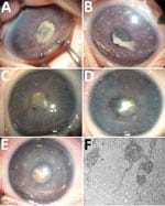 Thumbnail of Ocular anterior segment in 3 newborn infants with bilateral total cataract and anterior uveitis related to endogenous Spiroplasma ixodetis infection. A, B) Case-patient 1. Right (A) and left (B) eyes of a 4-week-old girl showing total cataract, posterior synechiae due to a cyclitic fibrinic membrane, and large keratic precipitates more visible in the left eye. The immature iris vasculature is dilated in the context of anterior segment inflammation. C, D) Case-patient 2. Right (C) an