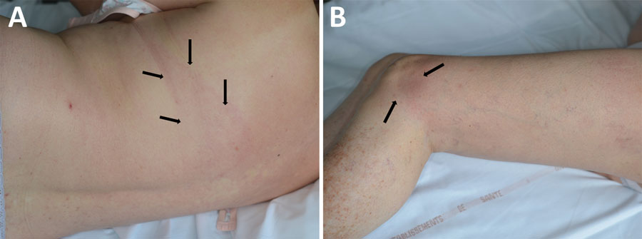 Large erythema chronicum migrans rash on a 60-year-old woman in France that was later determined to be caused by Borrelia spielmanii. A) Edges of linear erythema band on patient's back, indicated by arrows. B) End of linear erythema band beginning on patient's back, indicated by arrows on patient's knee. 