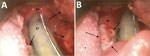 Video laryngoscopy images of patient larynx and pharynx in study of pharyngeal co-infections with monkeypox virus and group A Streptococcus, United States, 2022. A) View of oropharynx, hypopharynx, and laryngeal inlet of patient A (39-year-old man). Arrows indicate mpox lesions. B) Detailed view of mpox lesions. Arrows indicate several lesions. EP, epiglottis; ET, endotracheal tube; OP, oropharynx (lateral wall); T, tongue.