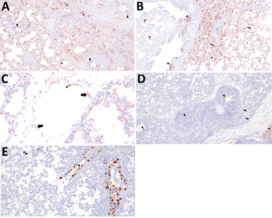 Immunohistochemical detection of influenza A virus nucleoprotein antigen in swine infected with H5N1 highly pathogenic avian influenza belonging to the goose/Guangdong 2.3.4.4b hemagglutinin phylogenetic clade. A) Extensive labeling of pneumocytes lining alveolar septa (arrows) and respiratory epithelium lining bronchioles (arrowheads) in the lung of pig 794 infected with A/bald eagle/FL/22 necropsied at 3 days postinoculation (dpi). Hematoxylin & eosin stain; original magnification ×40. B) Extensive labeling of pneumocytes lining alveolar septa (arrow), respiratory epithelium lining a bronchus (arrowheads), cell membrane of alveolar macrophages (chevron), and within the cytoplasm and nucleus of alveolar macrophages consistent with viral replication (notched arrow) in the lung of pig 798 infected with A/bald eagle/FL/22 necropsied on 5 dpi. Hematoxylin & eosin stain; original magnification ×40. C) Labeling in the cytoplasm (arrows) and nucleus (arrowhead) of endothelial cells in the lung of pig 791 infected with A/bald eagle/FL/22 necropsied on 3 dpi. Hematoxylin & eosin stain; original magnification ×200. D) Labeling of respiratory epithelium lining a bronchus (arrowheads), within the cytoplasm and nucleus of alveolar macrophages consistent with viral replication (notched arrow), rarely pneumocytes (arrow), in the lung of pig 58 infected with A/raccoon/WA/22 necropsied on 3 dpi. Hematoxylin & eosin stain; original magnification ×40. E) Abundant labeling of respiratory epithelium lining a bronchiole (arrowheads) and within the cytoplasm and nucleus of alveolar macrophages consistent with viral replication (notched arrow) in the lung of pig 78 infected with A/redfox/MI/22 necropsied on 3 dpi. Hematoxylin & eosin stain; original magnification ×100.