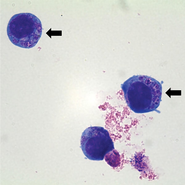 Anaplasma phagocytophilum cultured in human promyelocytic cells, showing morulae as basophilic and intracytoplasmic inclusions (arrows). Wright-Giemsa stain. Original magnification x1,000. Image: Emerg Infect Dis. 2014;20:1708–11.