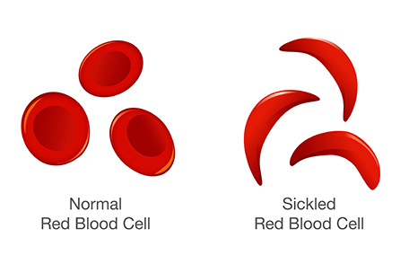 Sickle Cell Has Many Faces
