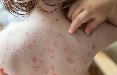 Chickenpox Vaccine
