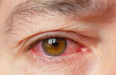 Pink Eye: What to Do