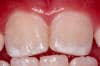 Image of mild fluorosis. Teeth show white opaque areas covering an extensive portion, but not as much as 50%, of the total surface.