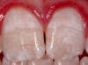Image of moderate fluorosis. All surfaces of teeth affected with opaque areas and teeth show marked wear and brown staining. 