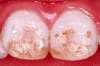 Image of severe fluorosis. All enamel surfaces of teeth are affected and the teeth do not exhibit normal development. The teeth are pitted and brown staining is also apparent.