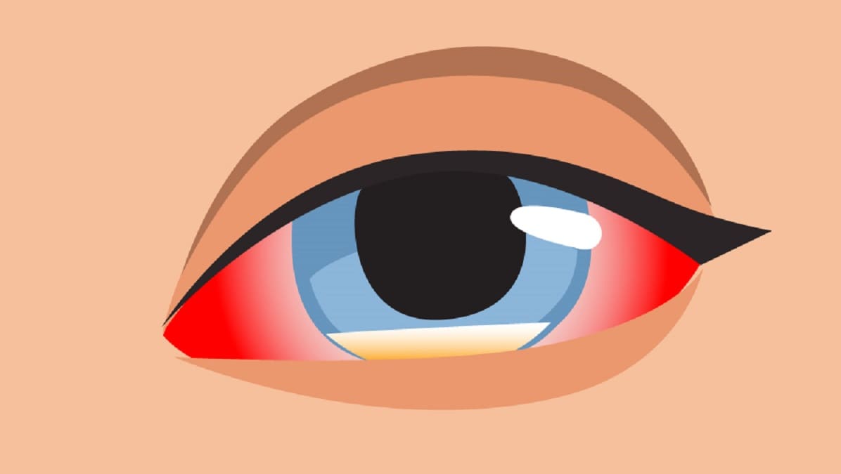 Drawing of an eye that is red, watery, and experiencing a fungal infection.