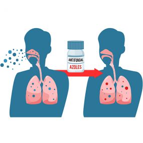 Image of a man before and after antifungal treatment. The man on the left is infected by a fungus, shown as blue dots entering through his nose and into his lungs. And arrow with a pill bottle of an antifungal containing azoles indicates treatment. The arrow points to the treated man, now with two different colored dots within his lungs, indicating resistant and non-resistant fungal spores.