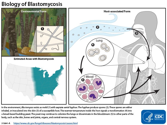In the environment, Blastomyces dermatitidis exists as mold (1) with septate aerial hyphae. The hyphae produce conidial spores (2). These spores are either inhaled, or inoculated into the skin (3) of a susceptible host. The warmer temperature inside the host signals a transformation (4) into a broad-based budding yeast. The yeast may continue to colonize the lungs or disseminate in the bloodstream (5) to other parts of the body, such as the skin, bones and joints, organs, and central nervous system.