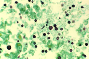 Grocott methenamine silver (GMS)-stain showing Cryptococcus in lung tissue