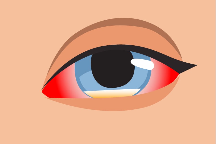 Illustration of an eye with redness on the sides