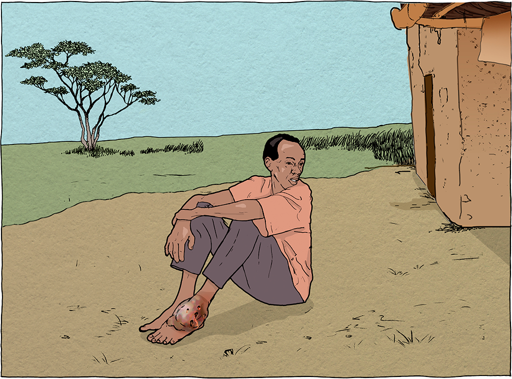 Graphic of a man sitting on the ground with mycetoma on his foot. 