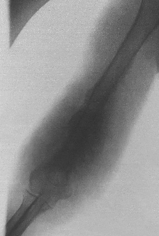 Anteroposterior radiograph of a patient’s right arm, revealing the bony involvement of the distal humerus in a case of actinomycetoma caused by Nocardia species
