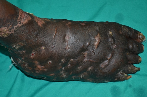 Massive eumycetoma of the right foot in a 40 year-old male patient from central Sudan caused by Madurella mycetomatis. Photo by Dr. Fahal, Mycetoma Research Center, Khartoum, Sudan
