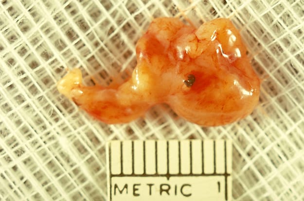 Specimen of fibroadipose tissue containing “black grain” mycetoma due to the fungus Madurella grisea.