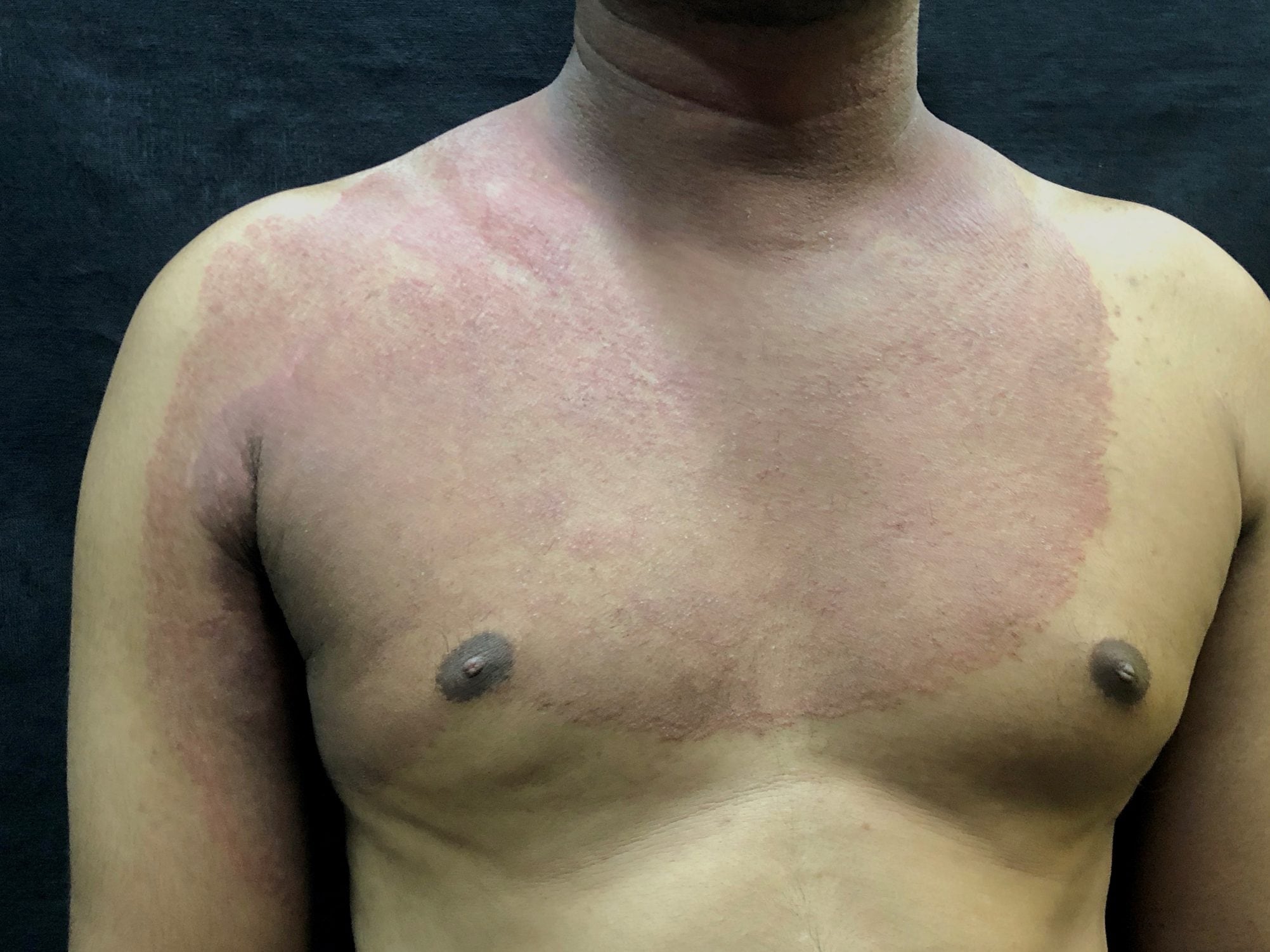 Ringworm rash from corticosteroid use covering a person’s upper body, neck, and arm.