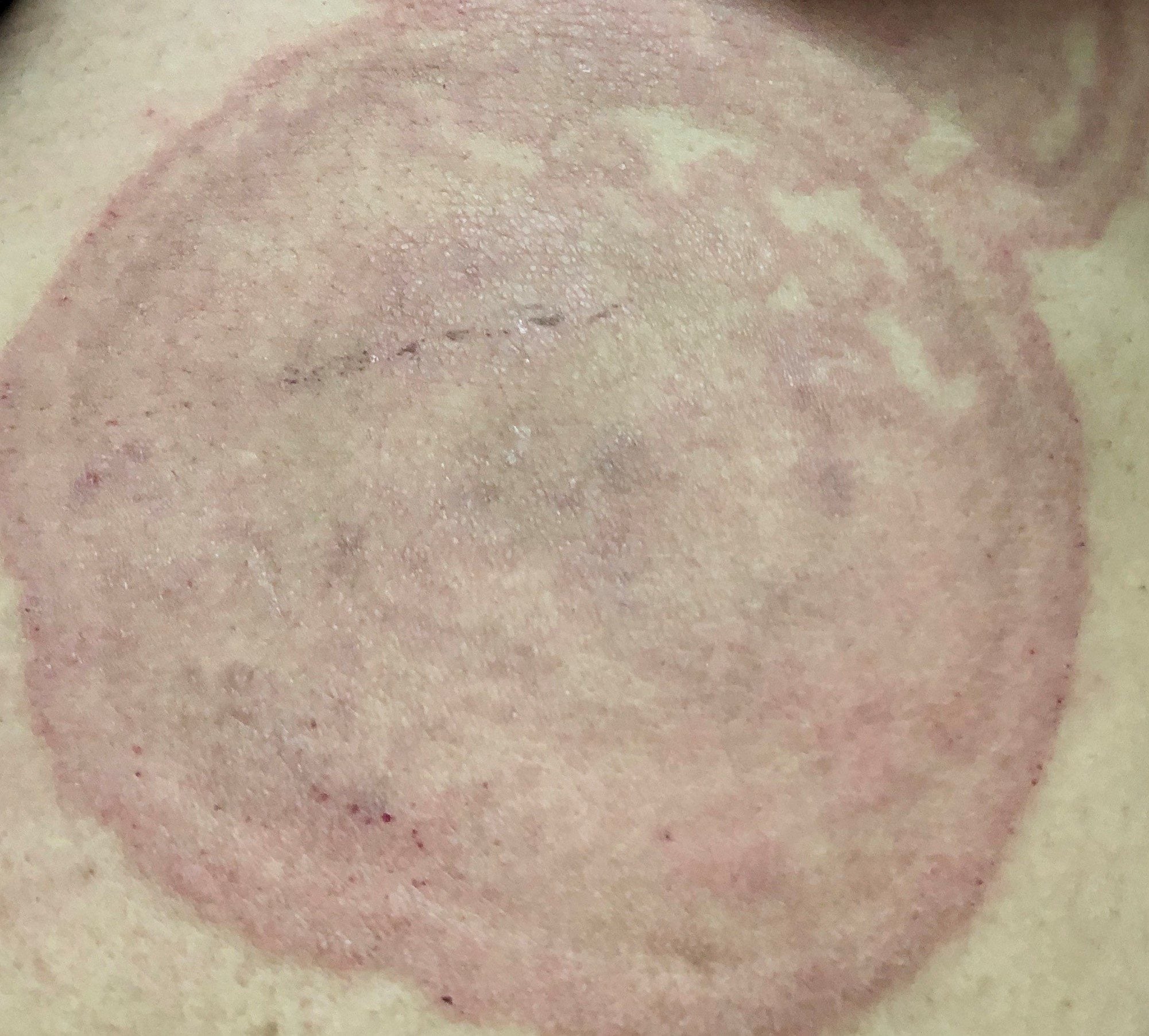 Image of corticosteroid medications can cause unusual patterns in ringworm rashes