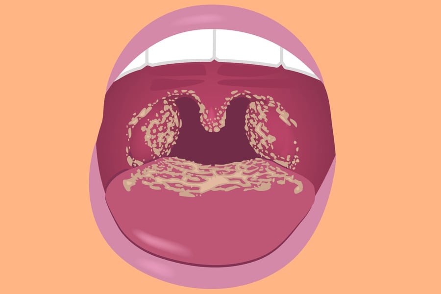 Graphic image of Candida infections of the mouth, throat, and esophagus