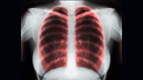 x rays of lungs