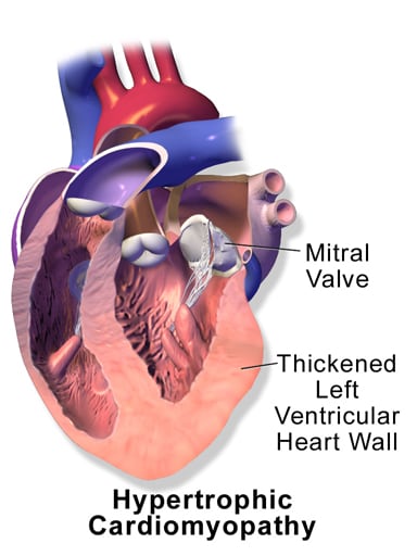 a heart with Hypertrophic Cardiomyopathy