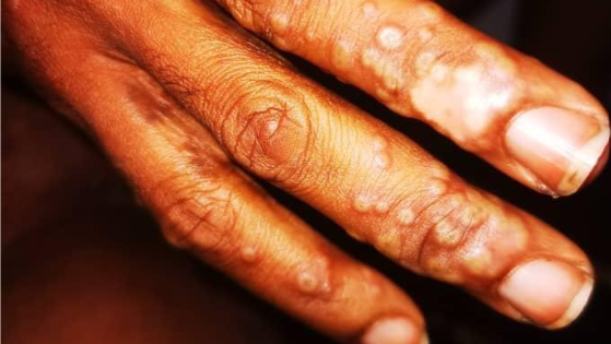 Skin lesions on a patient hand with monkeypox.