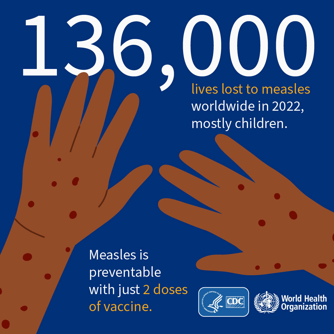 136,000 lives lost to measles worldwide in 2022, mostly children. Measles is preventable with just 2 doses of vaccine. CDC