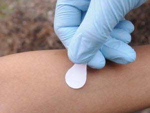 Photo of a person receiving the measles vaccine using microneedle patch