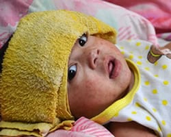 A baby girl with measles in the Phillipines