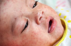A young baby in the hospital with measles in the Philippines.