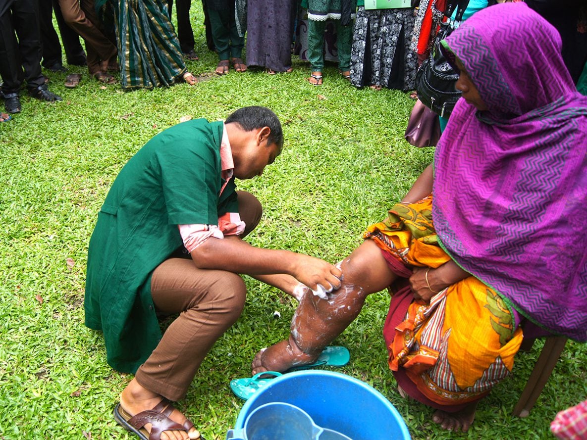 A healthcare worker teaches a woman with lymphatic filariasis in Bangladesh to care for her swollen leg to help prevent disability.