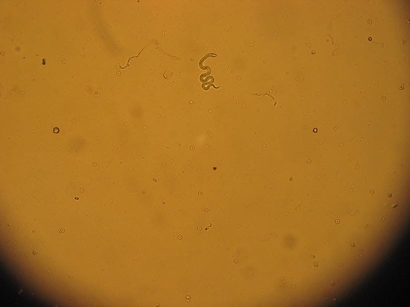 Within the human body, the adult female Onchocerca worm produces thousands of baby or larval worms (microfilariae) which migrate in the skin and the eye.