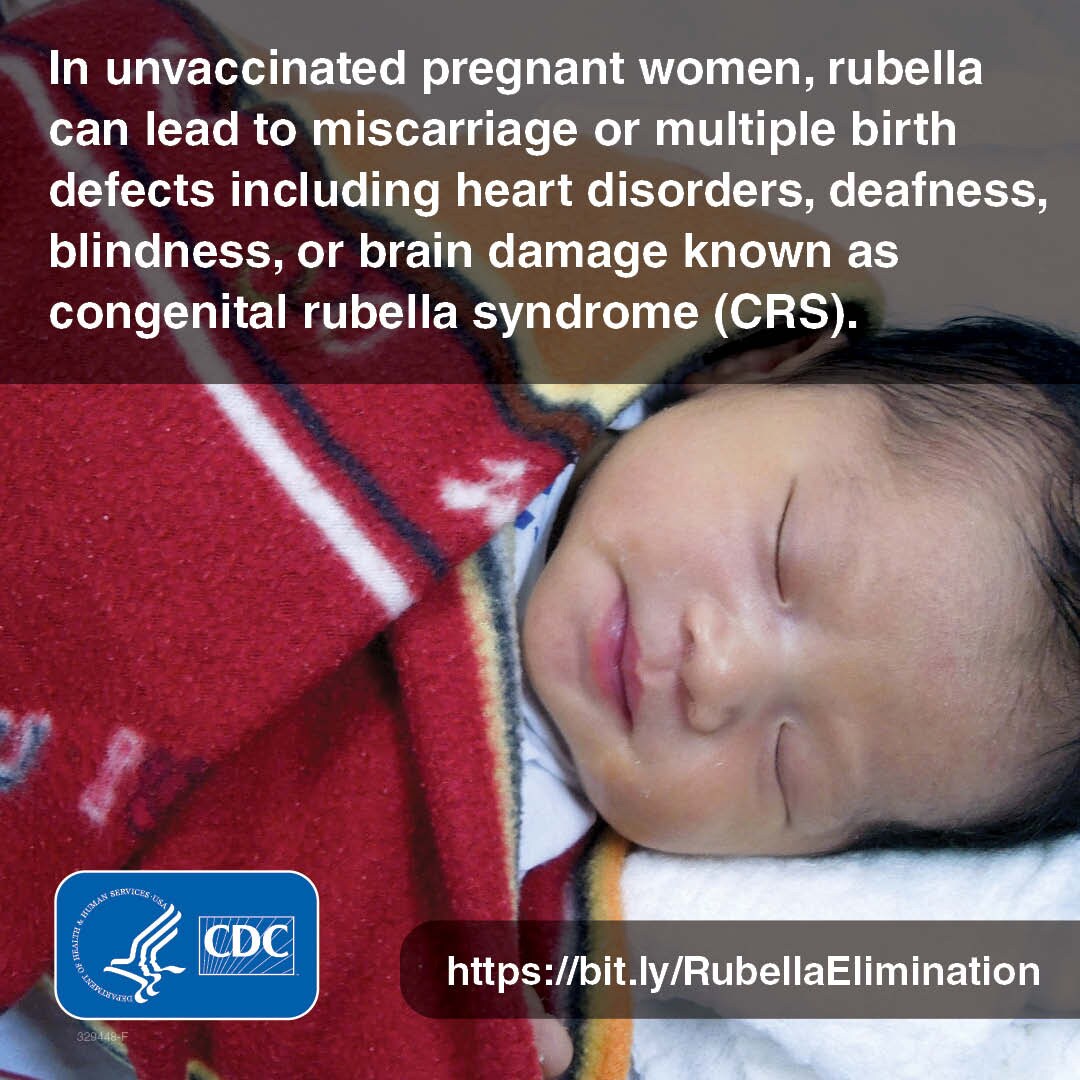 A baby born with congenital rubella syndrome (CRS) can have multiple defects https://bit.ly/RubellaElimination
