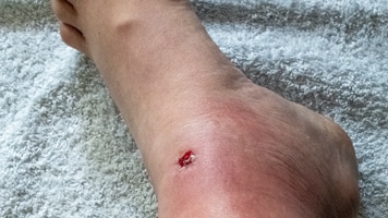 A wound on the lower left leg with signs of redness and swelling.