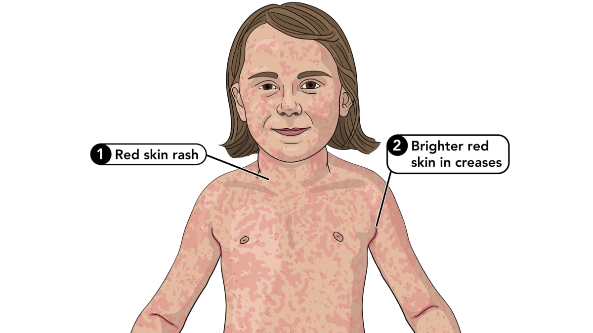 Illustration of a scarlet fever rash on a small child.