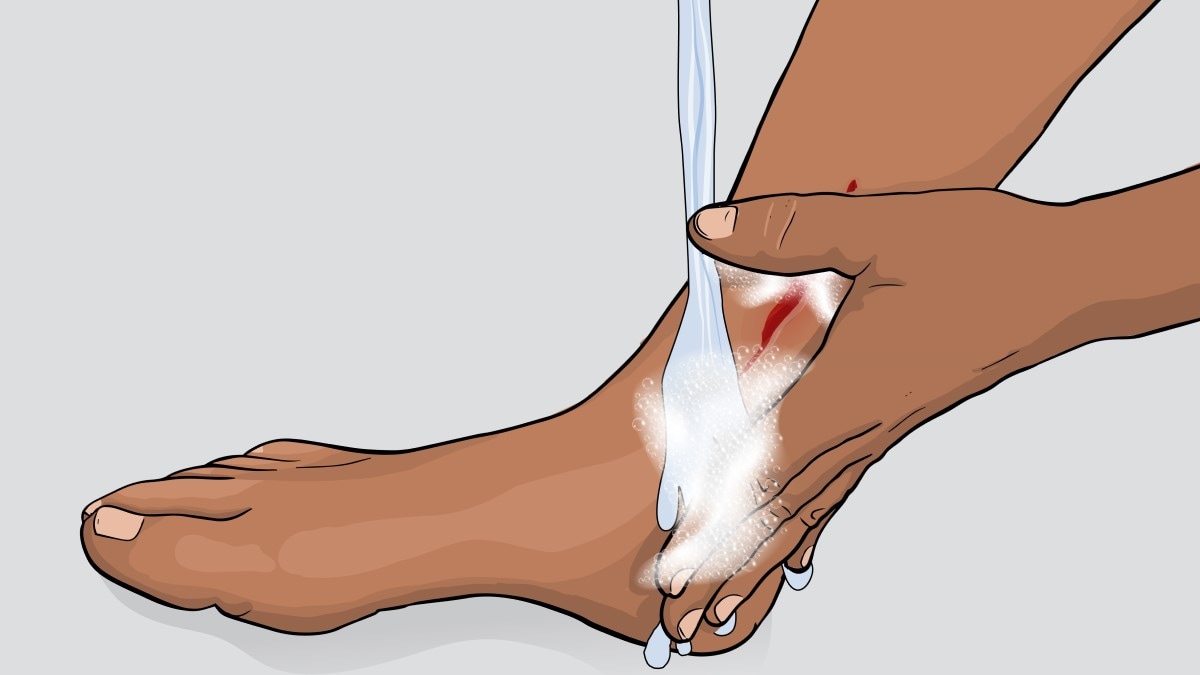 Illustration of a person cleaning an open wound on their leg by washing it with soap and water.