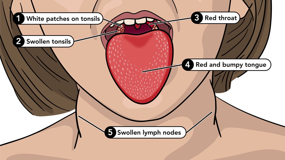 Symptom of scarlet fever include a red and bumpy tongue, red throat, swollen tonsils, and swollen lymph nodes.