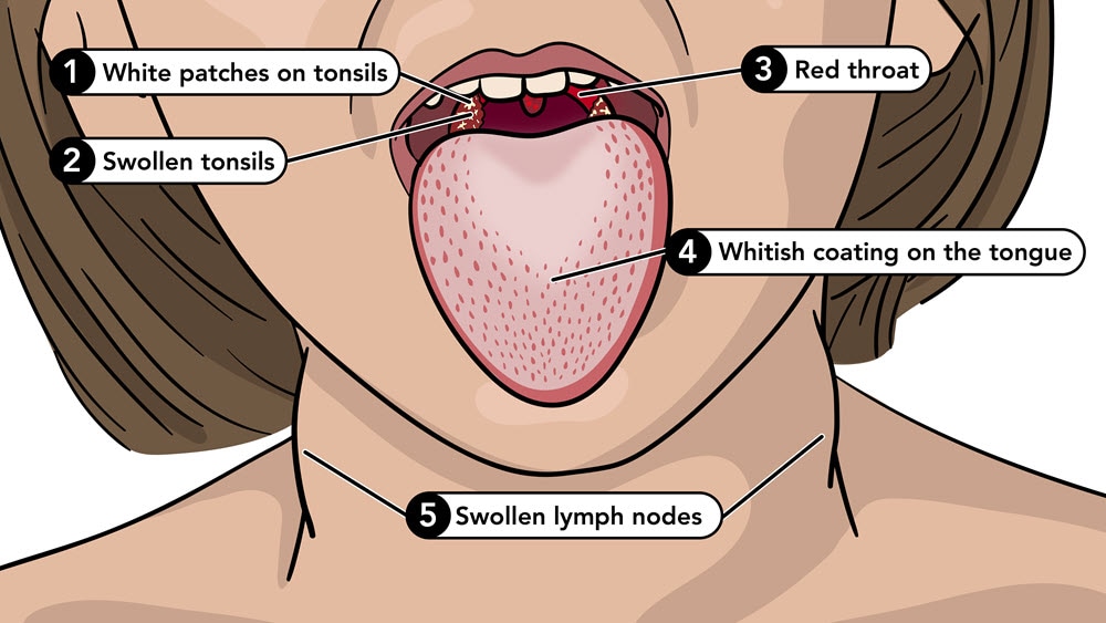 Symptom of scarlet fever include a white tongue, red throat, swollen tonsils, and swollen lymph nodes.