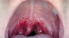 Patient exhibiting redness and edema of the oropharynx, and petechiae.