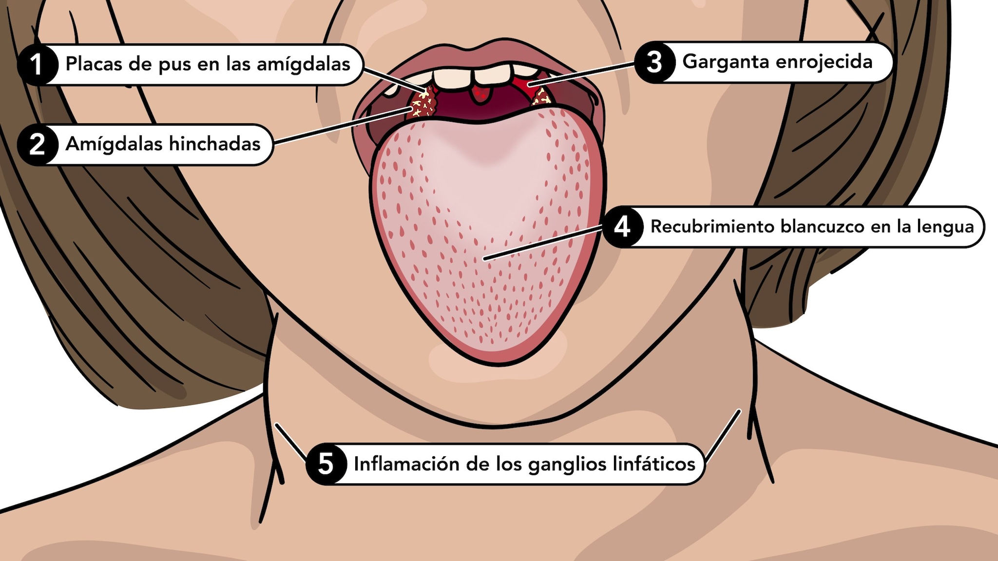 Primer plano de la boca de una niña con los primeros síntomas de escarlatina.