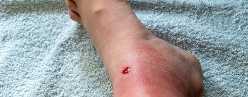 Herida punzante infectada en el pie de una persona