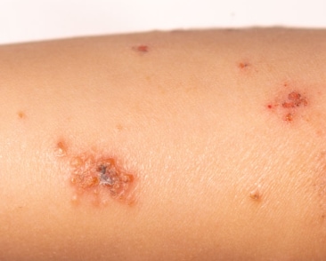 Imagen de las llagas causadas por los estreptococos del grupo A en el brazo de un niño.