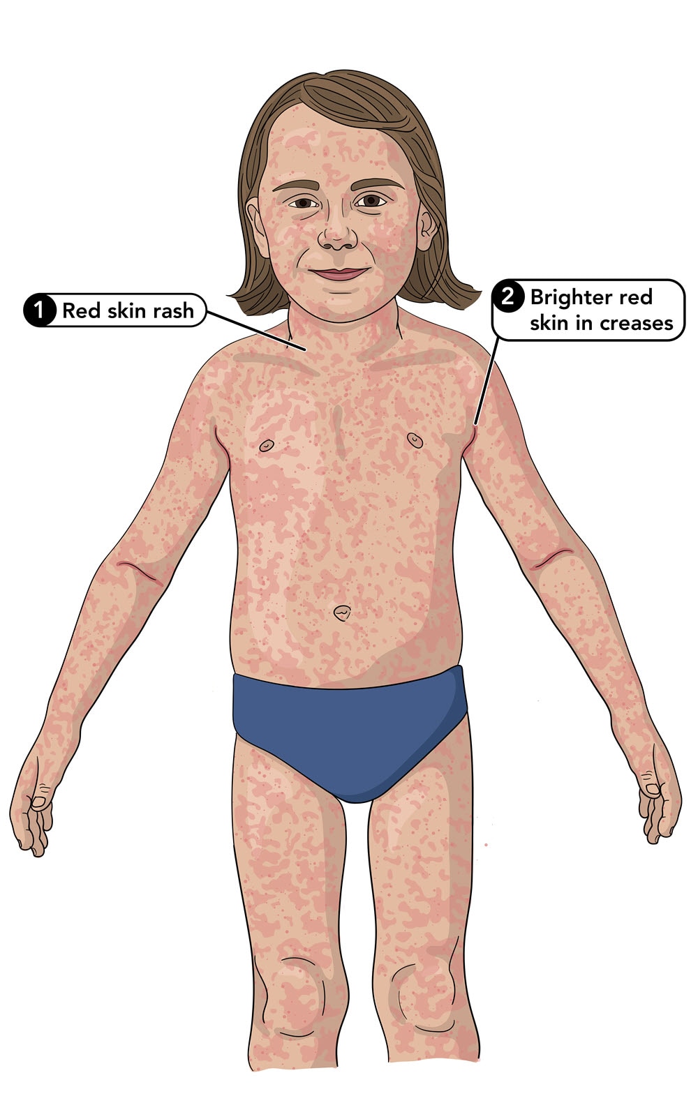 Scarlet fever rash on a small child that also shows pastia lines on skin creases.