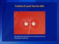 Positive D-zone Test for GBS
