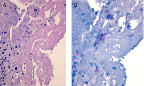 Microscopic views of fungus in a hip joint from patients who have arthritis, fibrin, and necrotic debris.
