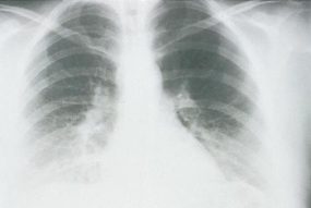 x-ray view of lungs of a patient in the first stage wiht HPS