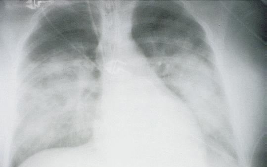 x-ray view of lungs of a patient in the second stage with HPS